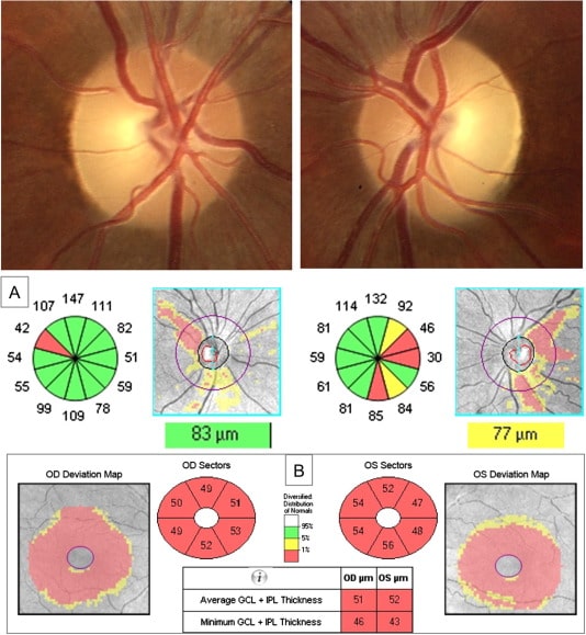 GLAUCOMA CLINIC IN NASHIK — Bapaye Eye Hospital, Nashik