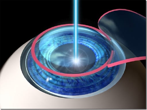 LASIK at Bapaye Eye Hospital, Nashik
