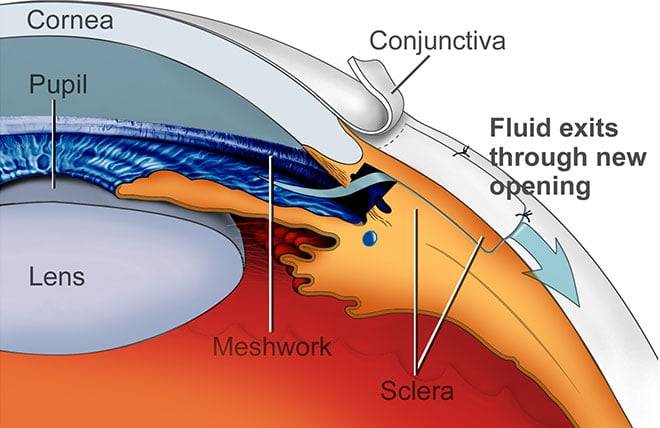 GLAUCOMA CLINIC IN NASHIK — Bapaye Eye Hospital, Nashik