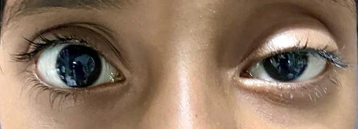 Pediatric Ophthalmology — Bapaye Eye Hospital, Nashik