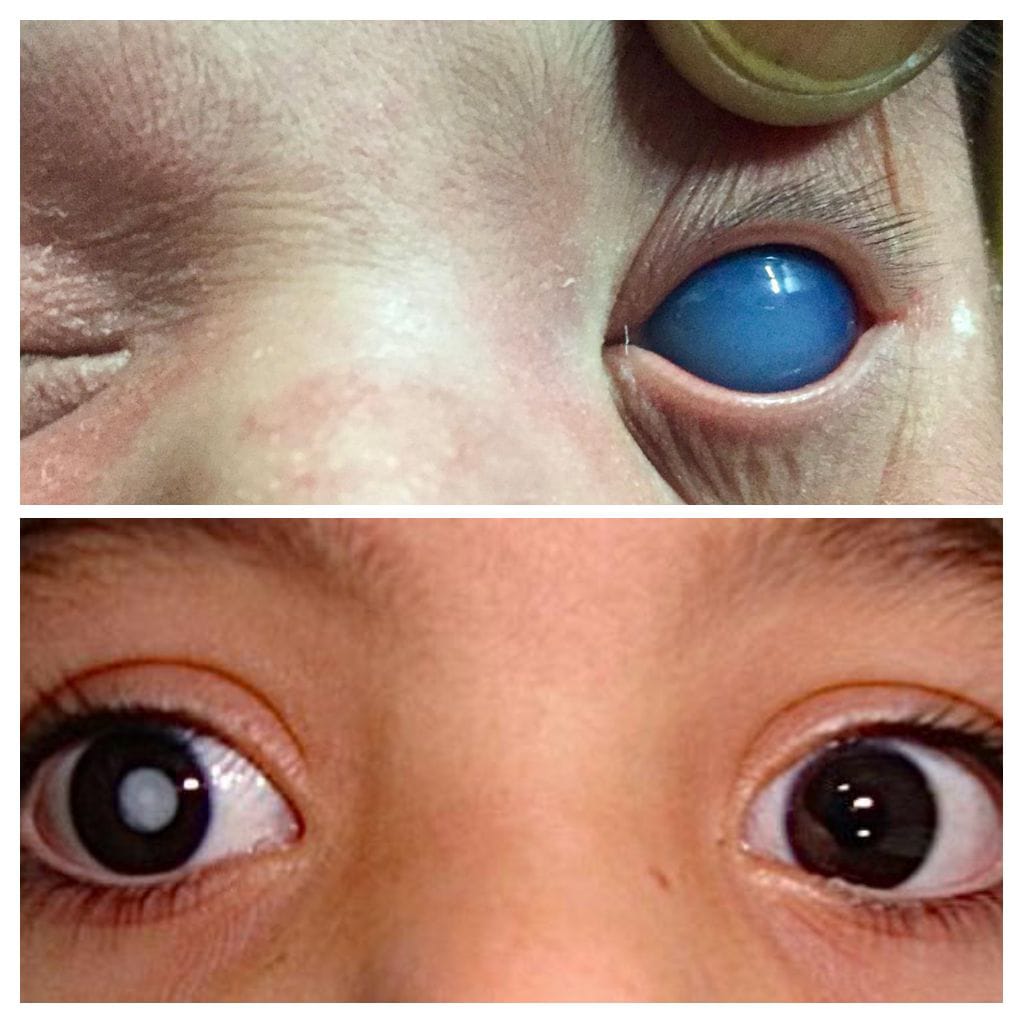 Pediatric Ophthalmology — Bapaye Eye Hospital, Nashik