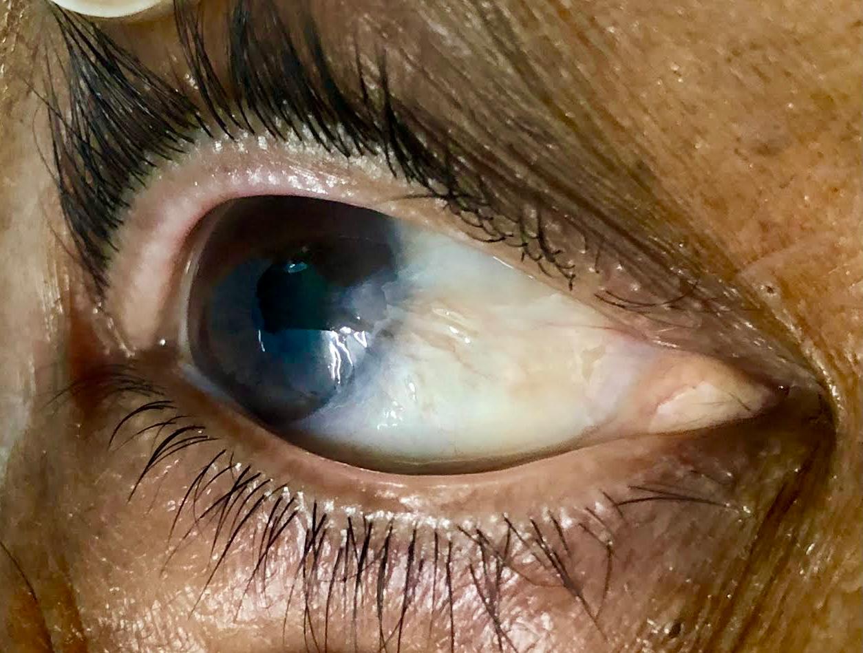 CORNEA CLINIC IN NASHIK — Bapaye Eye Hospital, Nashik