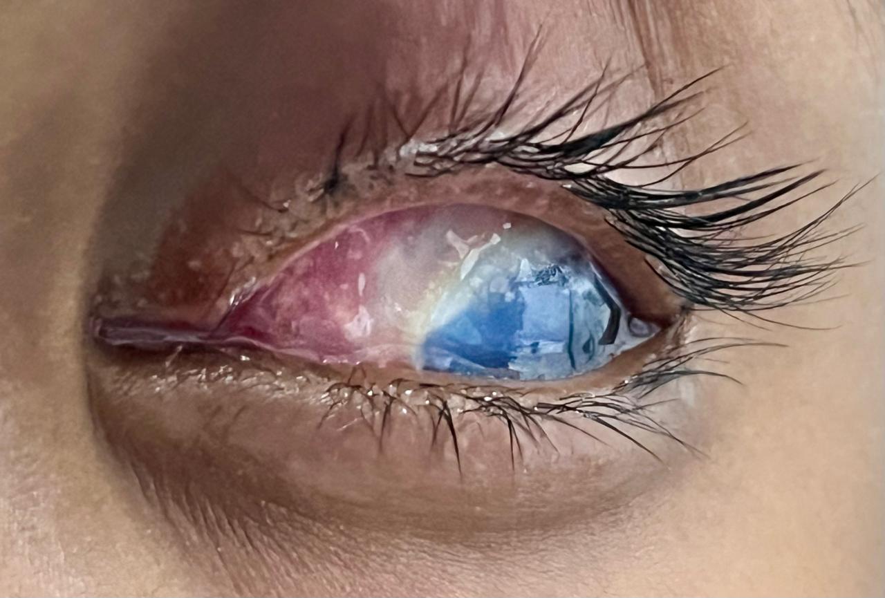 CORNEA CLINIC IN NASHIK — Bapaye Eye Hospital, Nashik