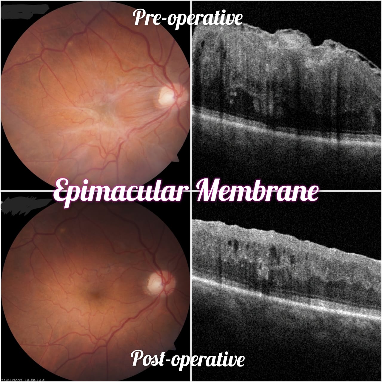 What is Epiretinal membrane? — Bapaye Eye Hospital, Nashik