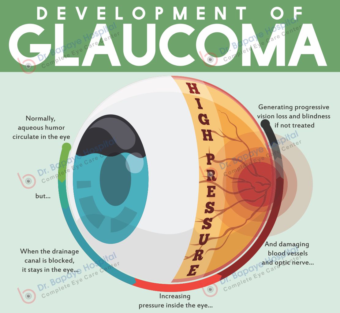 GLAUCOMA CLINIC IN NASHIK — Bapaye Eye Hospital, Nashik