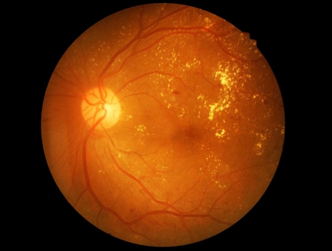 Retina care at Bapaye Eye Hospital, Nashik