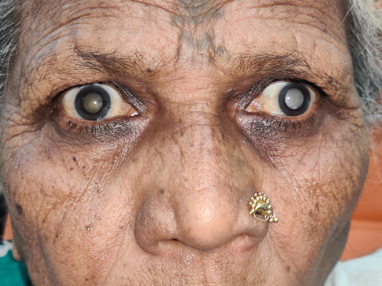 Cataract Treatment in Nashik. 4 Lakh+ Happy Patients