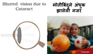 cataract meaning in marathi